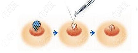 乳頭縮小手術的適應人群 乳頭縮小手術的適應人群