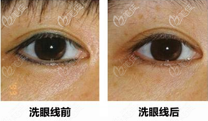 蜂巢皮秒激光去眼線的對比圖 蜂巢皮秒激光去眼線的對比圖