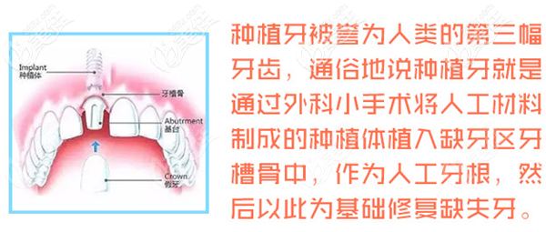 種植牙的優(yōu)勢 種植牙的優(yōu)勢