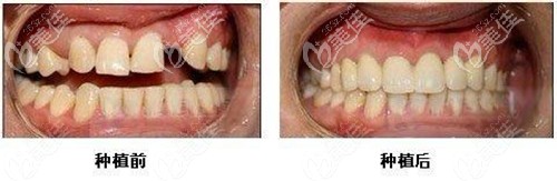 福州登特口腔做韓國登騰即刻種植牙案例 福州登特口腔做韓國登騰即刻種植牙案例