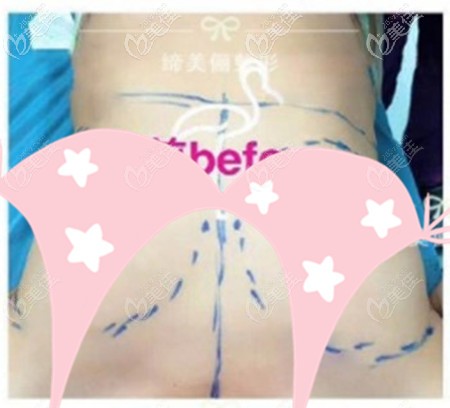 做假體隆胸前的胸部基礎(chǔ) 做假體隆胸前的胸部基礎(chǔ)