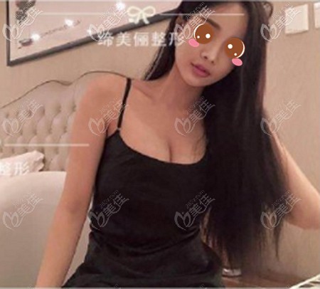 做假體隆胸四個(gè)月后的效果 做假體隆胸四個(gè)月后的效果