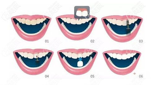 門牙牙縫大做牙貼面過程