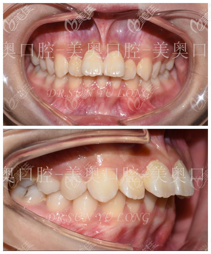 13歲的小豪替牙期出現(xiàn)牙齒前突,影響美觀 13歲的小豪替牙期出現(xiàn)牙齒前突,影響美觀