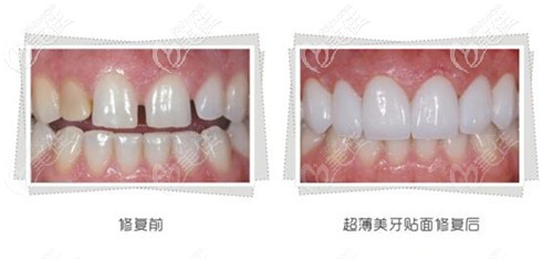 門牙牙縫大做牙貼面效果