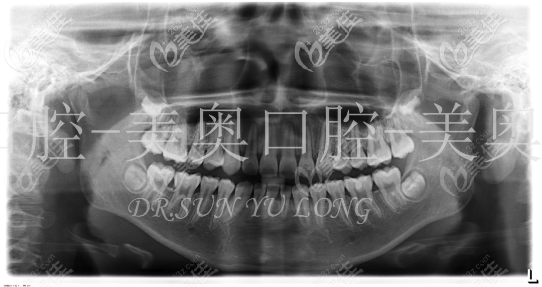 做牙齒矯正術(shù)前的全景片 做牙齒矯正術(shù)前的全景片