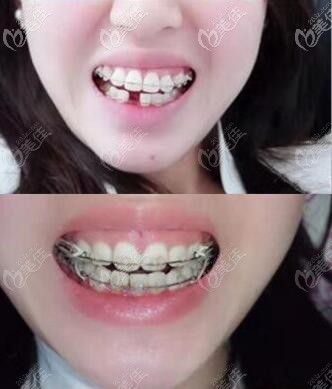 做牙齒矯正術(shù)前術(shù)后對(duì)比照