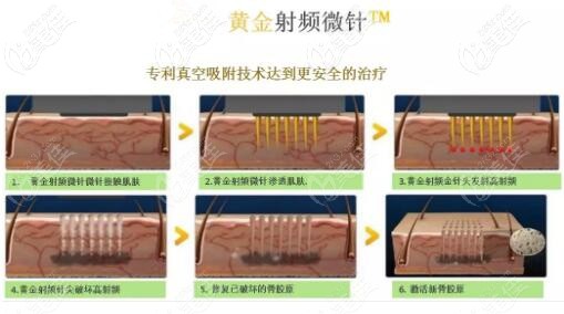 黃金射頻微針治療原理過程示意圖 黃金射頻微針治療原理過程示意圖