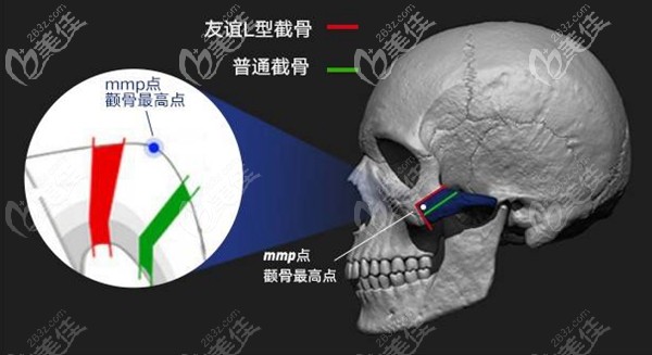 張立天L型截顴骨