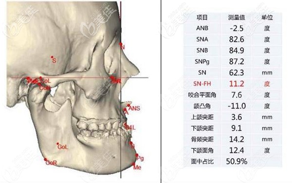 李運峰DPS輪廓整形術(shù)