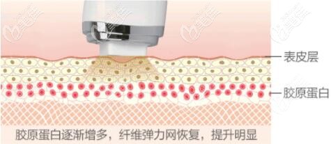 熱瑪吉治療過程示意圖