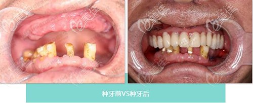 AIION6種植牙案例