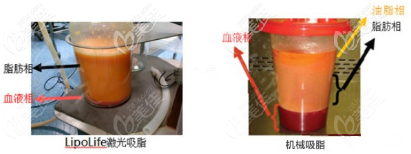 5G天使光雕吸脂活性高 5G天使光雕吸脂活性高