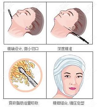 蘭州仁和抽脂用的是負(fù)壓式吸脂 蘭州仁和抽脂用的是負(fù)壓式吸脂