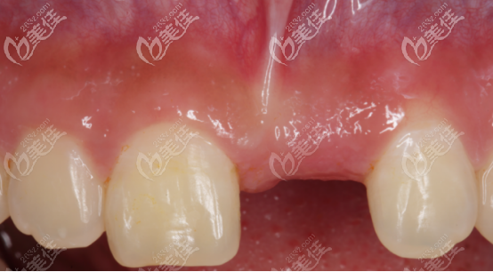 術前正面門牙照片 術前正面門牙照片