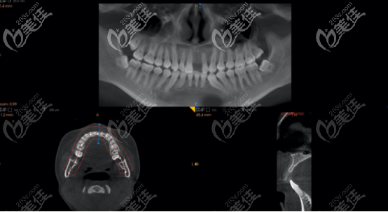 術前拍攝的ct 術前拍攝的ct