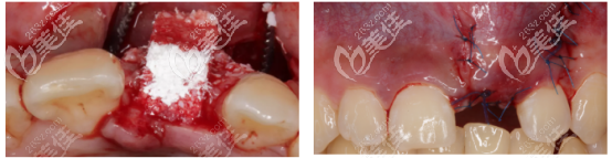 植入骨粉的樣子 植入骨粉的樣子