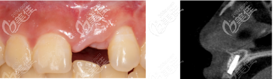 確認骨量沒有吸收的ct片子 確認骨量沒有吸收的ct片子