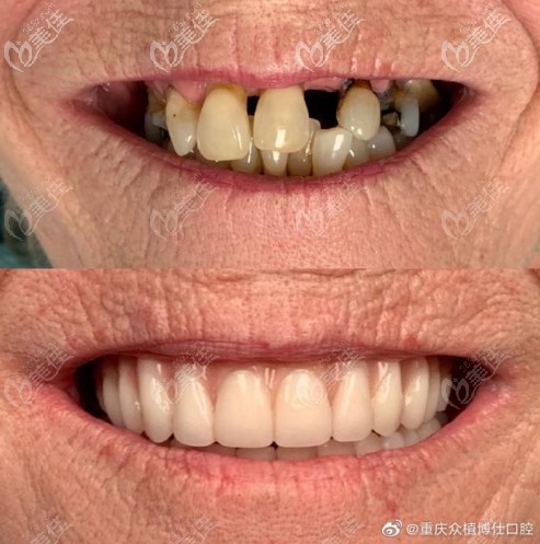 80歲老人在重慶眾植博仕口腔做allon4全口種植牙，當(dāng)天種牙當(dāng)天戴牙冠