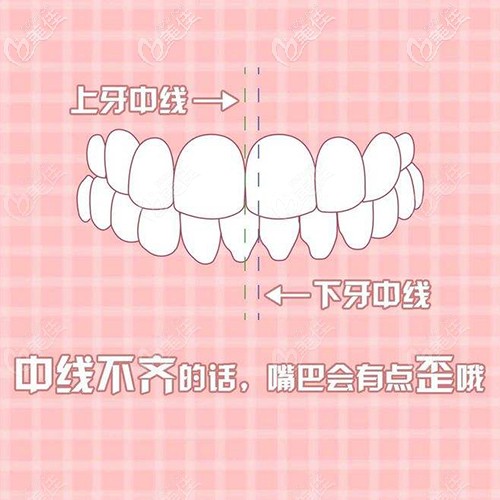 牙齒中線不齊的自測方式