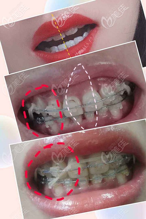 金屬牙套矯正牙齒中線不齊