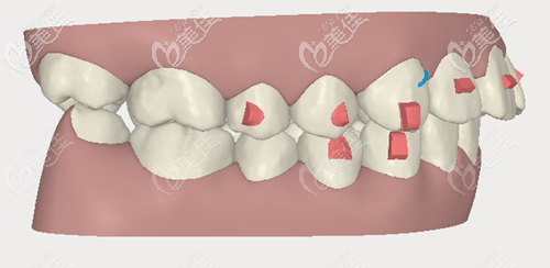 隱適美矯正凸嘴 隱適美矯正凸嘴