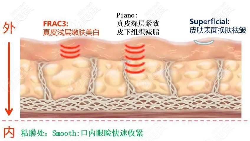 歐洲之星去眼袋主要用的是SMOOTH模式
