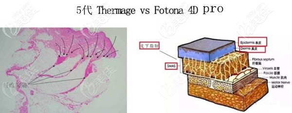 Fotona4D Pro和五代熱瑪吉治療肌膚層次不同