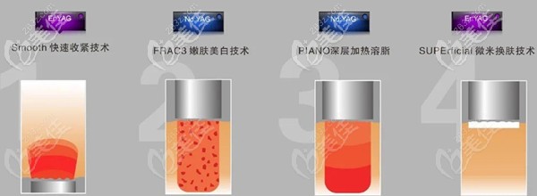 Fotona 4D Pro是通過4個不同模式針對不同層次治療