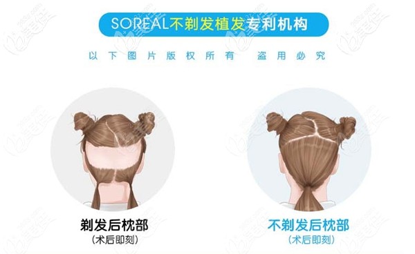 首瑞不剃發(fā)種植專屬機構(gòu) 首瑞不剃發(fā)種植專屬機構(gòu)