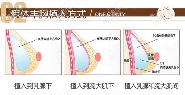 壹加壹曼托假體隆胸植入方式