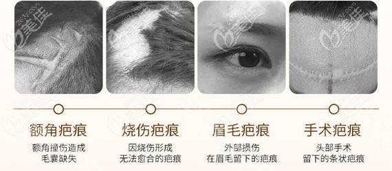 燒傷、燙傷、刀疤疤痕可以植發(fā)嗎