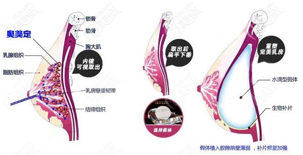 奧美定取出后要定制版3D智能基因生物補片修補缺損部位