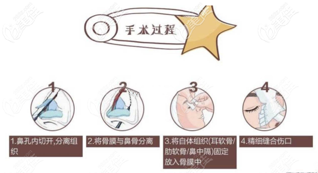 耳軟骨隆鼻過程圖解