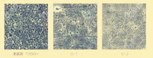 國產(chǎn)美晶瓷全瓷牙的使用壽命更長