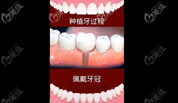 種植牙三期術(shù)后佩戴牙冠