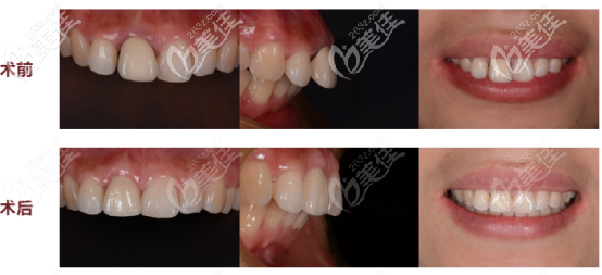 上門牙做種植的術(shù)前術(shù)后對比圖 上門牙做種植的術(shù)前術(shù)后對比圖