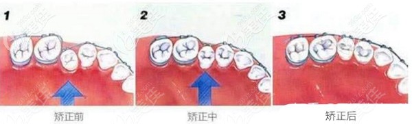 牙齒矯正的效果