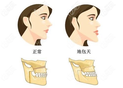 反頜做完牙齒矯正的效果