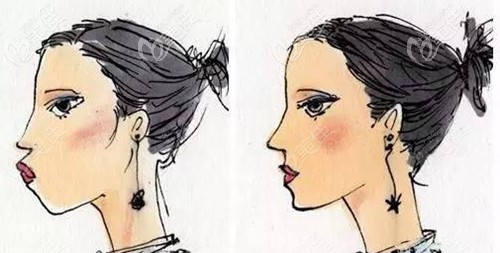 齙牙做完牙齒矯正的效果