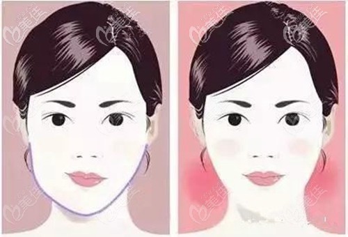 偏頜做完牙齒矯正的效果