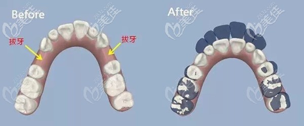 矯正牙齒前必要時還得拔牙