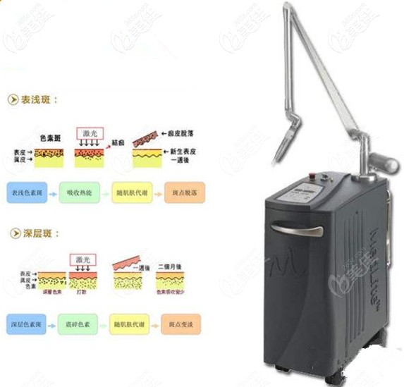 C6激光祛斑效果不錯 C6激光祛斑效果不錯