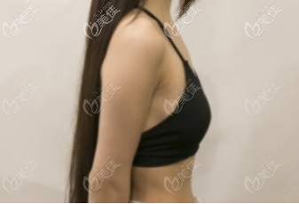 術(shù)前胸部側(cè)面照