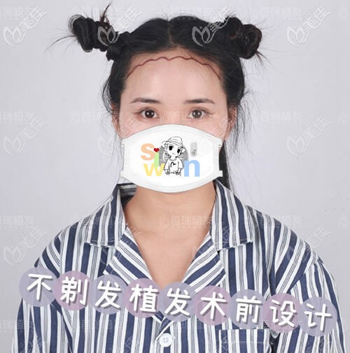 首瑞不剃發(fā)植發(fā)術(shù)前設(shè)計 首瑞不剃發(fā)植發(fā)術(shù)前設(shè)計