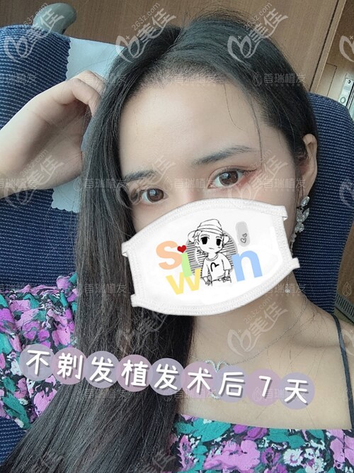 首瑞不剃發(fā)植發(fā)術(shù)后7天 首瑞不剃發(fā)植發(fā)術(shù)后7天