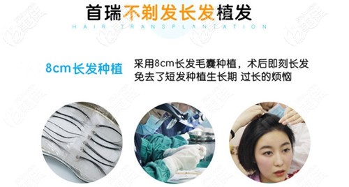 首瑞的不剃發(fā)長發(fā)植發(fā)技術(shù) 首瑞的不剃發(fā)長發(fā)植發(fā)技術(shù)