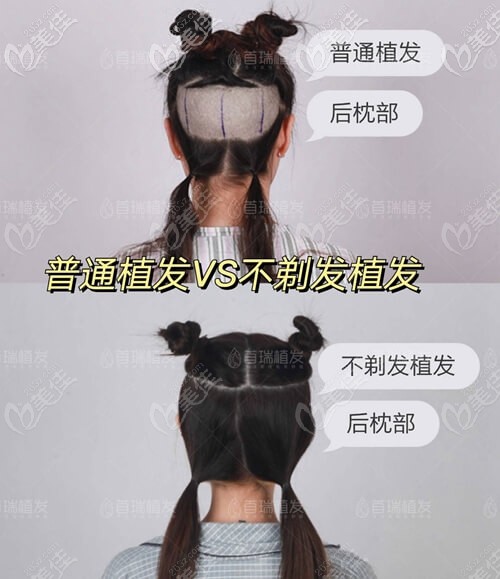 不剃發(fā)植發(fā)和剃發(fā)植發(fā)區(qū)別 不剃發(fā)植發(fā)和剃發(fā)植發(fā)區(qū)別