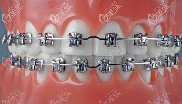 金屬托槽矯正牙齒的效果