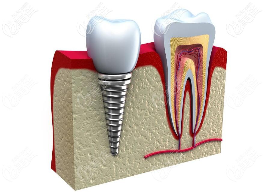 韓國(guó)登騰種植體好不好